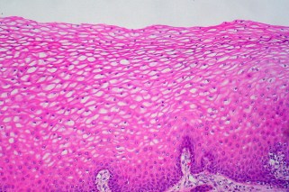 Normal cervical epithelium