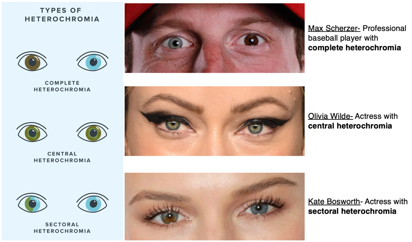 Heterochromia Seeing The World Through Different Colored Eyes Lions Heterochromia Seeing The World Through Different Colored Eyes Lions